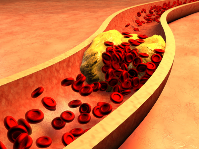 CHOLE11 cholesterol jak się pozbyć skutecznie