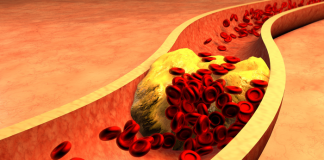 Jak obniżyć poziom cholesterolu? cholesterol jak się pozbyć skutecznie