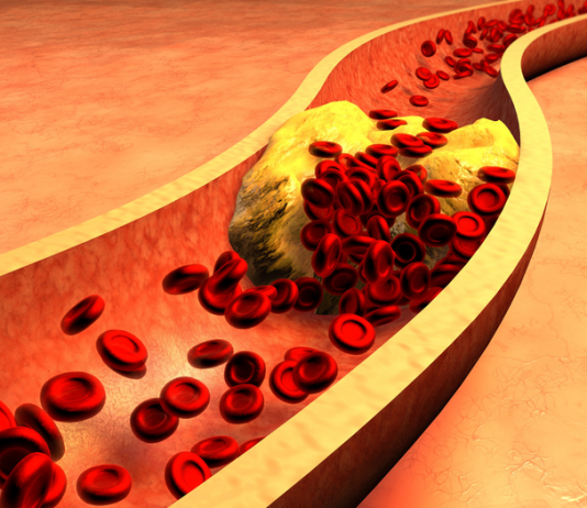 Jak obniżyć poziom cholesterolu? cholesterol jak się pozbyć skutecznie