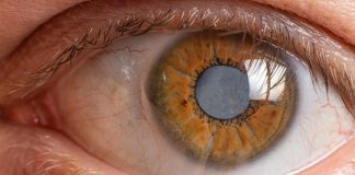 Jedyna skuteczna metoda leczenia zaćmy. Usunięcie zmętniałej soczewki zaćma oka