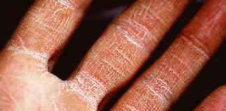 Jak dbać o dłonie z AZS? chora dłoń