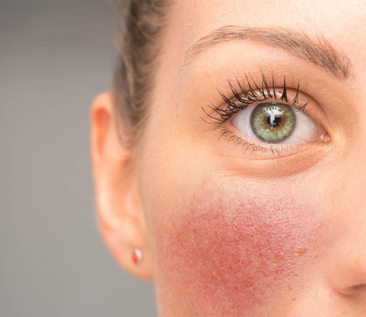 Trądzik różowany – 5 popularnych objawów, leczenie tradzik rozowaty kobieta