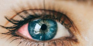 Alergia oczu – co zrobić, gdy się pojawia? oczy alergia