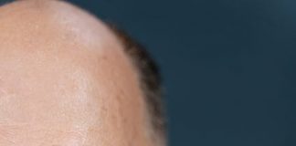 Przeszczep włosów – czym jest i dlaczego warto wykonać go w Turcji? brak wlosow