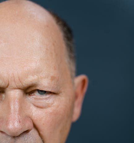 Przeszczep włosów – czym jest i dlaczego warto wykonać go w Turcji? brak wlosow