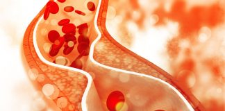 Kiedy poziom cholesterolu powinien martwić? wysoki cholesterol