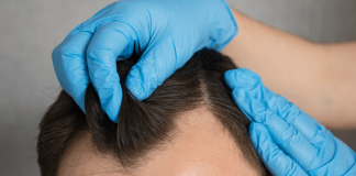 Dla kogo zabieg przeszczepu włosów będzie odpowiedni? przeszczep wlosow jak