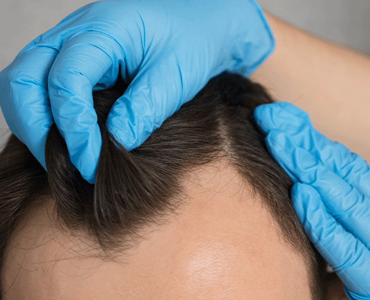 Dla kogo zabieg przeszczepu włosów będzie odpowiedni? przeszczep wlosow jak