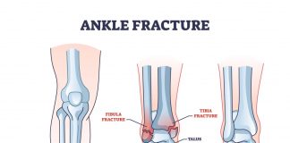Skręcona kostka – skuteczne leczenie, powikłania i rehabilitacja w domu Ostry ból przeszywa nogę przy każdym kroku po niefortunnym skręceniu stawu skokowego