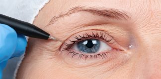 Chirurgiczna plastyka powiek opuchnięte powieki