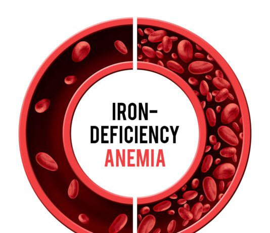 Niedobór żelaza w organizmie: bezpieczna suplementacja bez diagnostyki laboratoryjnej Żelazo bez konsultacji lekarskiej można suplementować tylko w okresie intensywnego krwawienia miesiączkowego