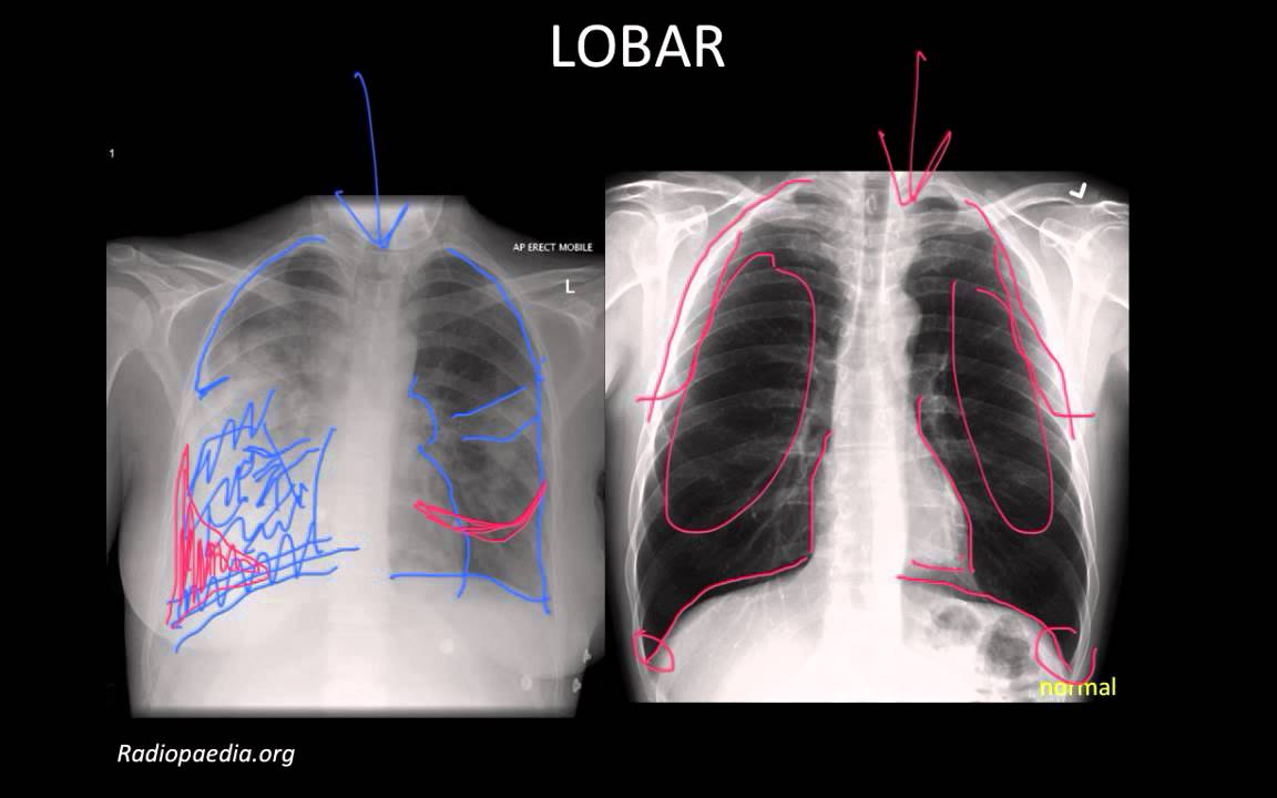 Duży obszar konsolidacji z powietrzem pod opłucną na RTG