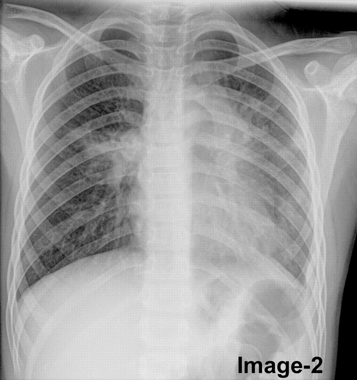 Zmniejszone zacienienia w płucach po leczeniu na RTG kontrolnym