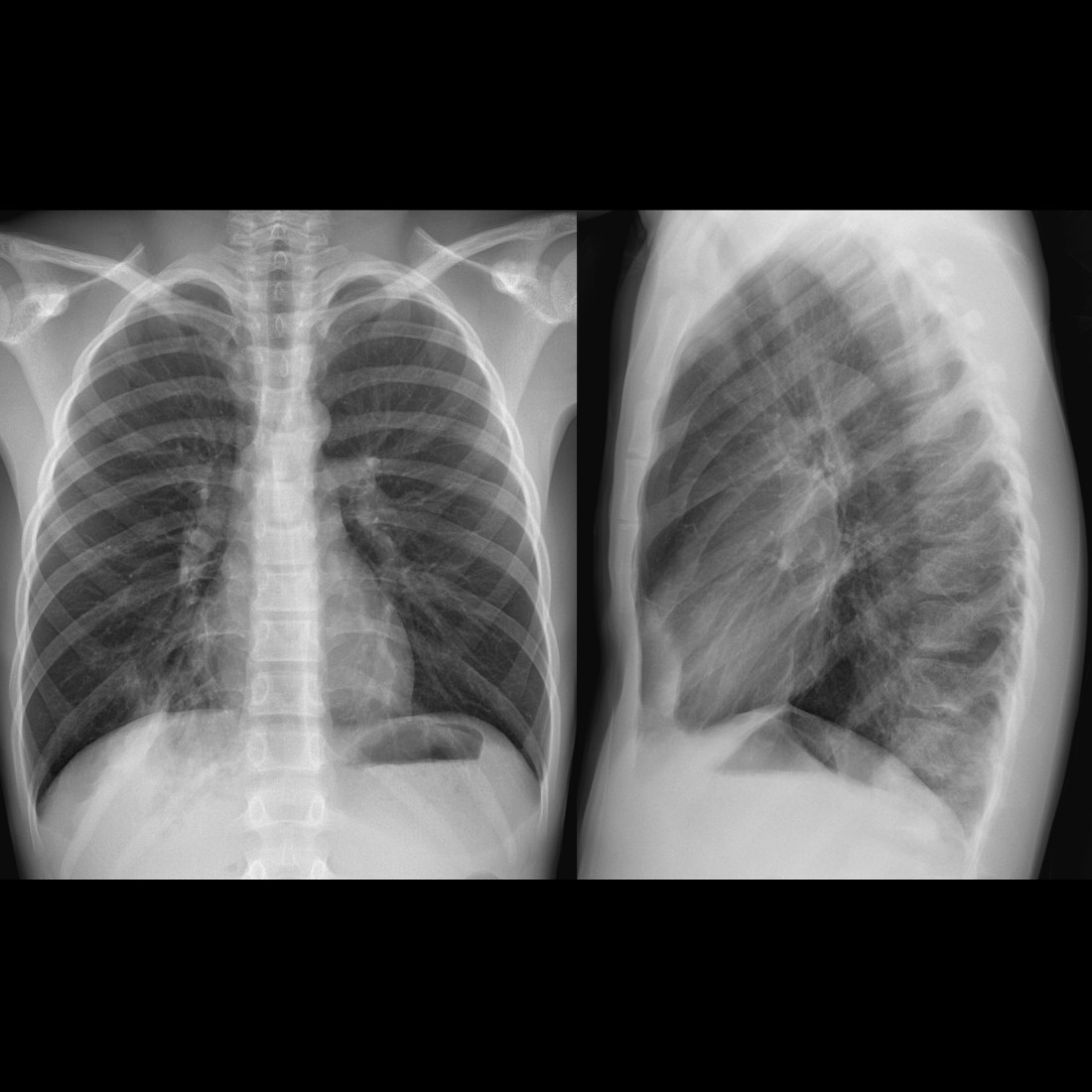 Lobarna konsolidacja lewego płuca z wyraźnymi granicami na RTG