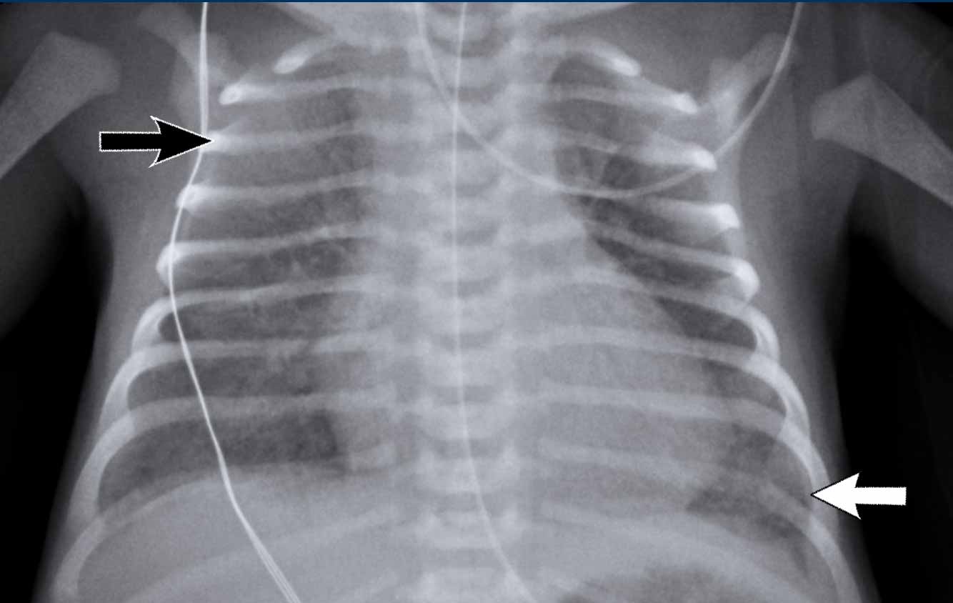 Rozproszone infiltraty w górnych płatach płuc widoczne na RTG