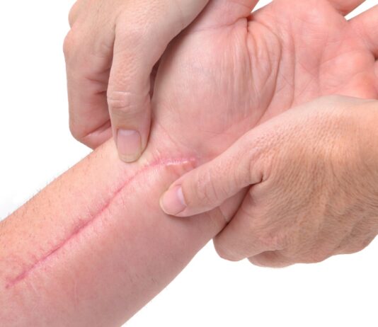 Masaż powięziowy, terapia bliznowa, mobilizacja tkanek – które techniki manualne najszybciej wygładzą bliznę? Fizjoterapeuta masujący widoczną bliznę na skórze ramienia pacjenta rękami