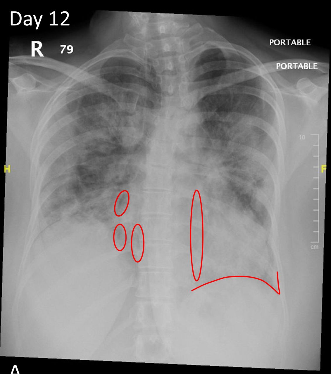 Porównanie RTG zdrowych płuc i z zapaleniem pokazujące różnice