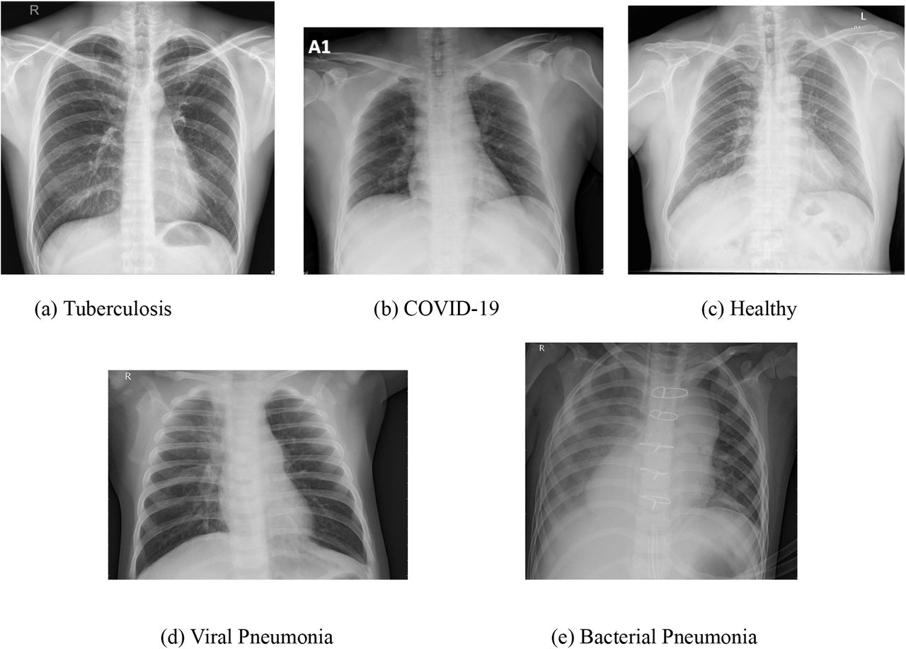 Drobne guzkowate zacienienia w obu płatach na RTG dziecka