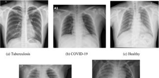 Jak wygląda zapalenie płuc na zdjęciu RTG? Zacienienia, nacieki i zagadki, które widzi radiolog RTG klatki piersiowej z obustronnymi zacienieniami w dolnych płatach płuc