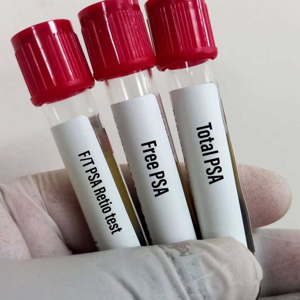 rzucanie palenia dla zdrowia prostaty starszy mężczyzna rzucający papierosa do popielniczki na balkonie